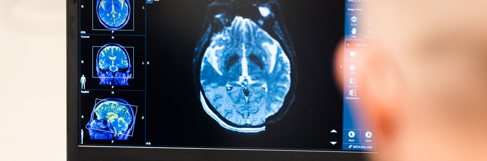 Deep Brain Stimulation in Europe: Innovation Meets Practice